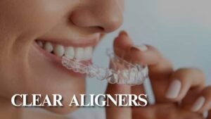 Clear Aligners
