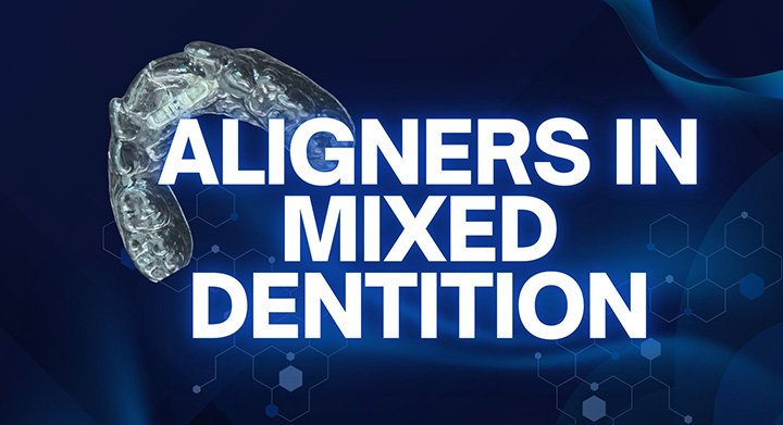 Aligners in Mixed Dentition