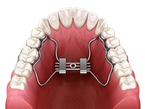 Palatal expander on a model of the upper teeth