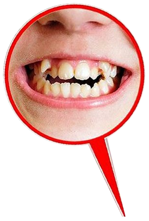 Close-up of crowded teeth in a child who breathes through the mouth