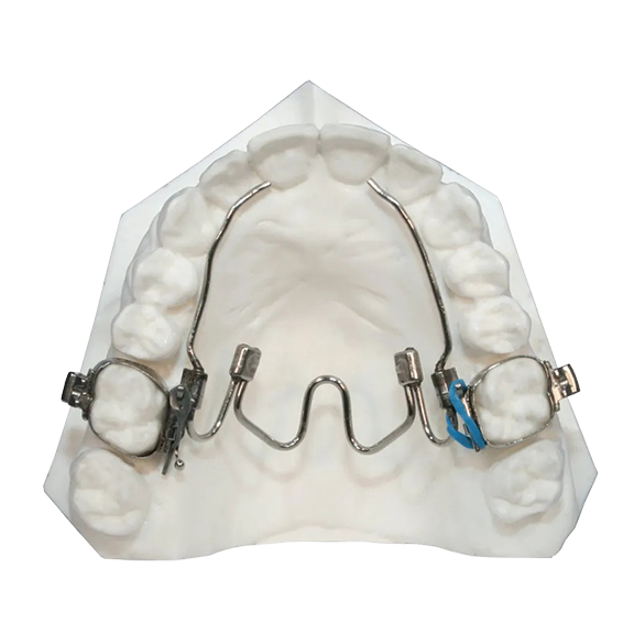 NiTi palatal expander on a dental model