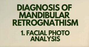 Diagnosis of mandibular retrognathism 1: facial photo analysis