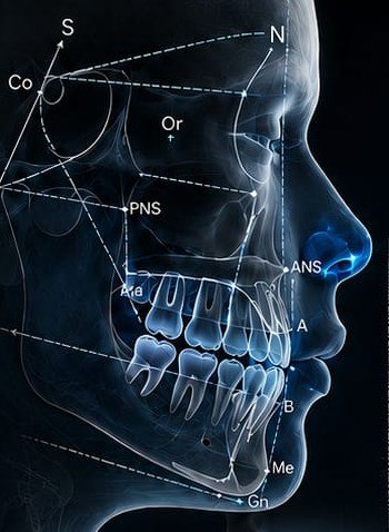 Cephalometric tracing of a skull profile with landmark analysis points