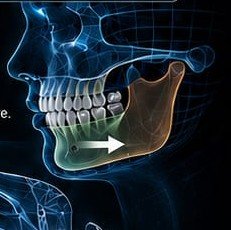 Mandibular growth guidance illustration